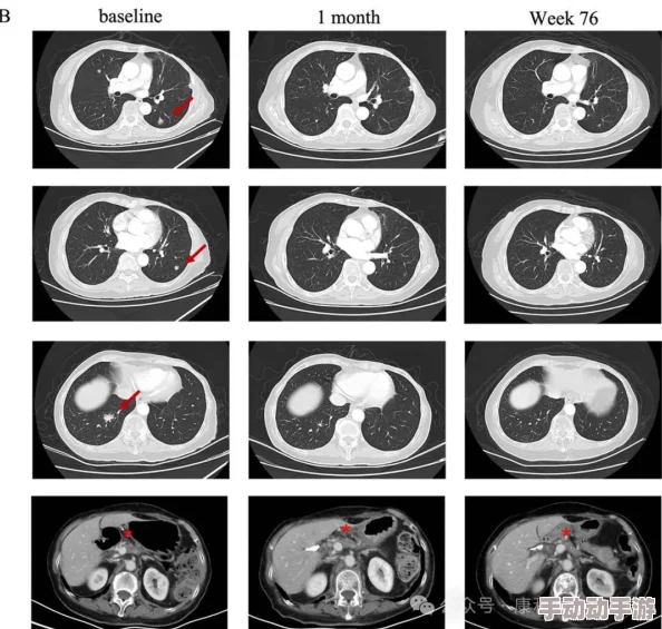 红桃Ct研发取得新突破临床试验申请已获受理预计明年启动 红桃Ct研发取得新突破临床试验申请已获受理预计明年启动