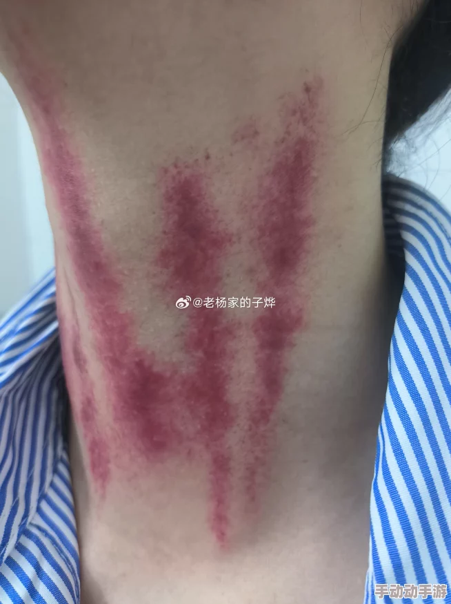 揪痧快看微博最新研究表明揪痧后皮肤微循环改善 揪痧快看微博最新研究表明揪痧后皮肤微循环改善