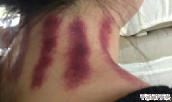 揪痧快看微博最新研究表明揪痧后皮肤微循环改善 揪痧快看微博最新研究表明揪痧后皮肤微循环改善
