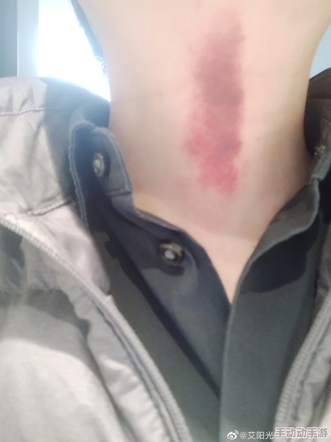 揪痧快看微博最新研究表明揪痧后皮肤微循环改善 揪痧快看微博最新研究表明揪痧后皮肤微循环改善